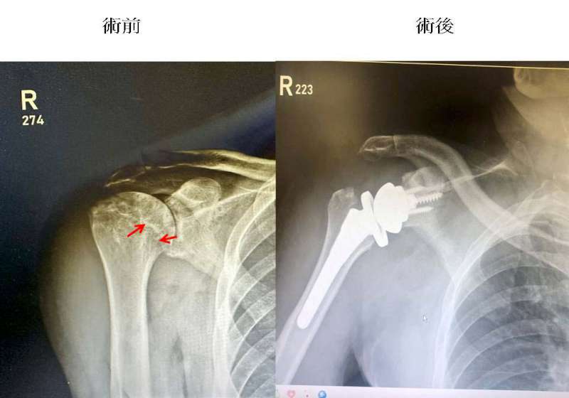 高市9旬翁長期打網球致右肩旋轉肌破關節退化 高雄秀傳紀念醫院精準置換人工關節