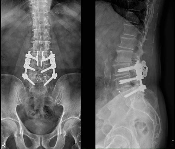 七賢脊椎外科醫院腰椎無鋼釘穩定器微創術 助7旬翁擺脫多年腰痛笑顏逐開