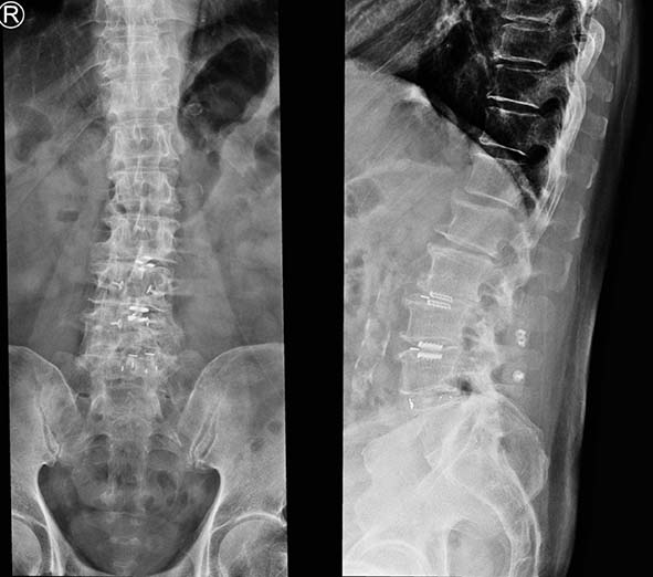 七賢脊椎外科醫院腰椎無鋼釘穩定器微創術 助7旬翁擺脫多年腰痛笑顏逐開