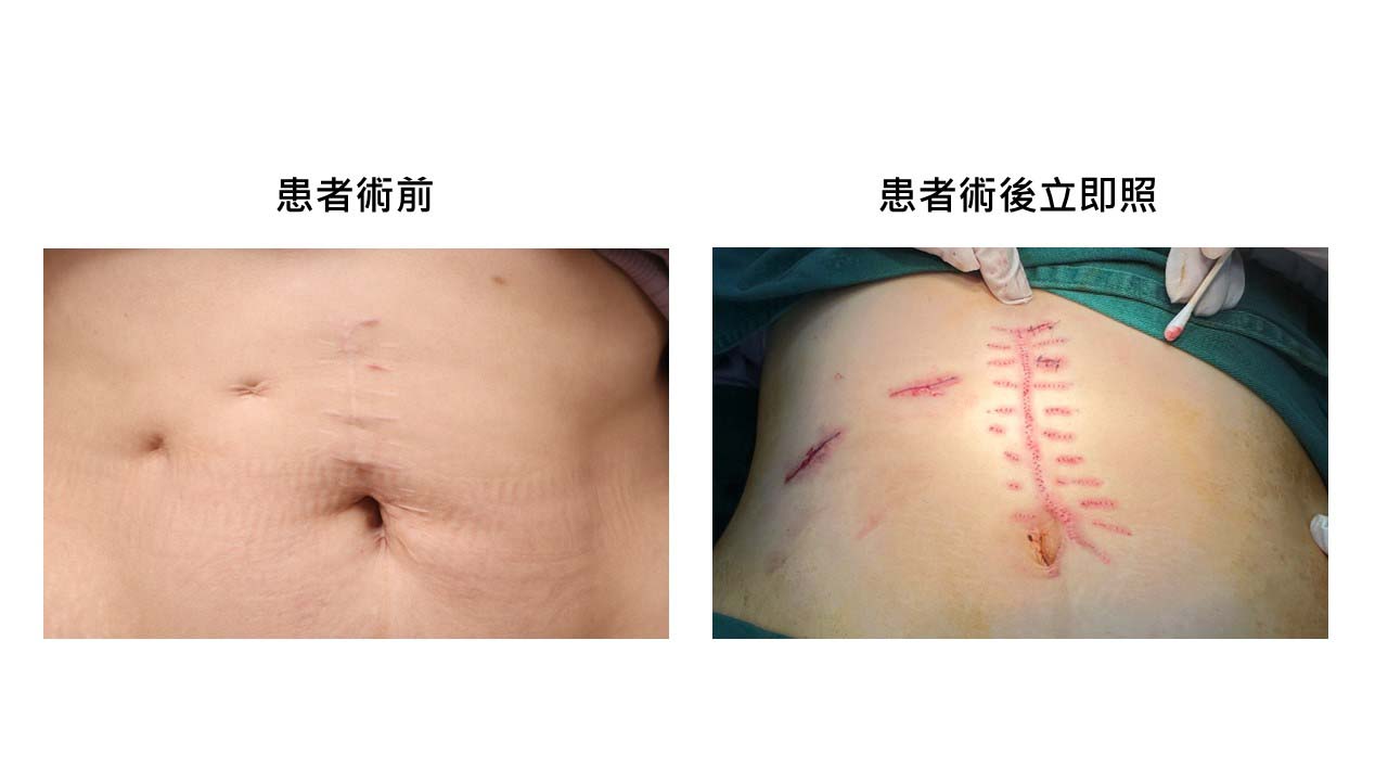 北部熟齡女急性膽囊炎剖腹留疤 國際白疤中心創辦人曹賜斌白疤顏色再生術整型整心