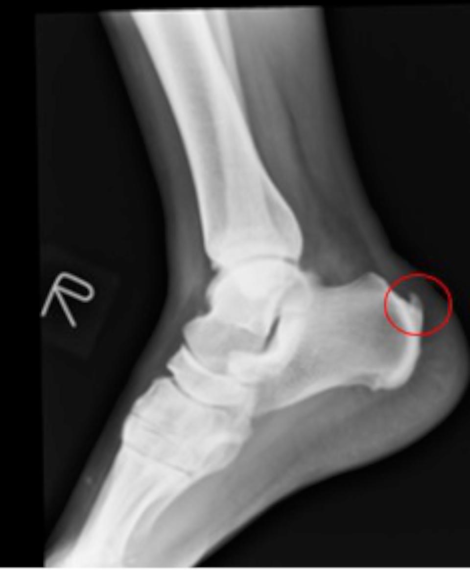 高市退休警罹足跟骨骨刺 七賢脊椎外科醫院微創關節鏡手術治癒