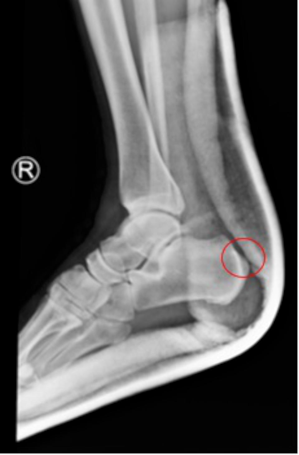 高市退休警罹足跟骨骨刺 七賢脊椎外科醫院微創關節鏡手術治癒
