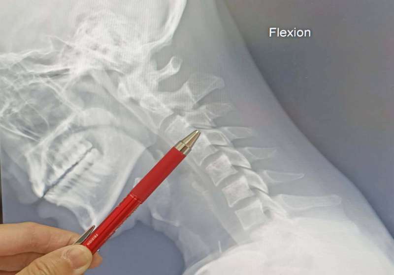 高市男子單車急煞扭傷頸椎致椎間盤突出 七賢脊椎外科醫院熱凝療法漸獲改善