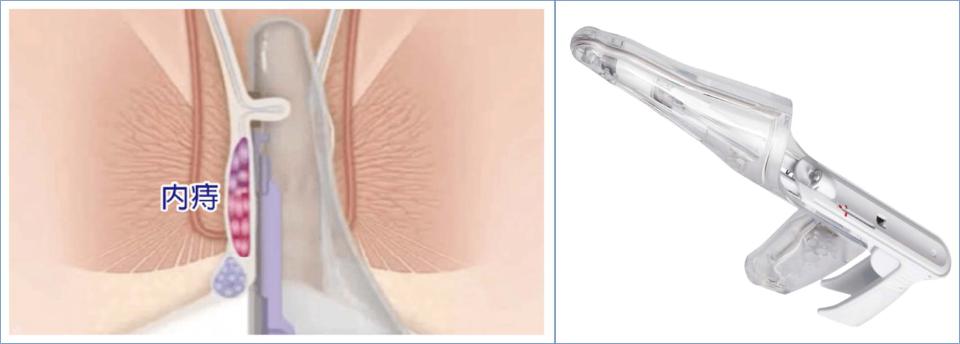 高市6旬女便秘痔瘡出血脫垂 民生醫院冷凝刀切除患部治癒