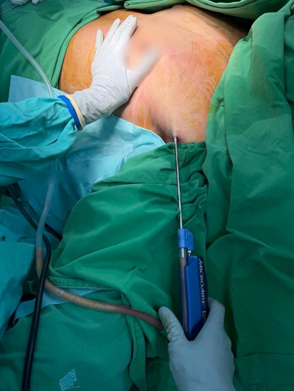 高醫超音波定位真空輔助乳房微創術 助男性女乳症病友擺脫困擾重建自信