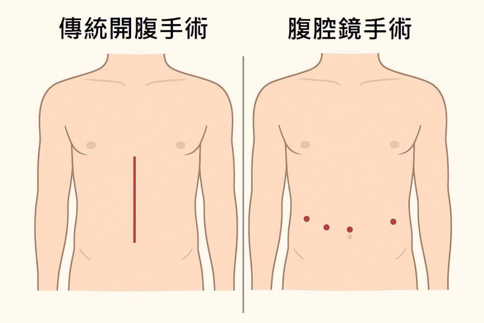高市7旬翁腹痛就醫確診中度分化腺癌 大同醫院腹腔鏡微創等3手術治療復原良好