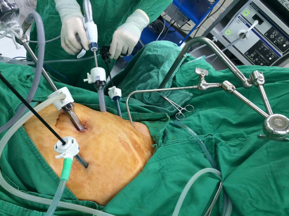 高市7旬翁腹痛就醫確診中度分化腺癌 大同醫院腹腔鏡微創等3手術治療復原良好