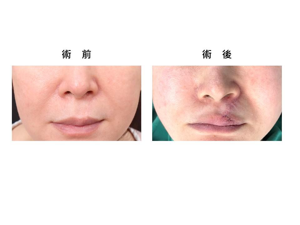 國際白疤中心創辦人曹賜斌獨創白疤顏色再生術 撫平新北市妙齡女兒時傷疤重拾自信