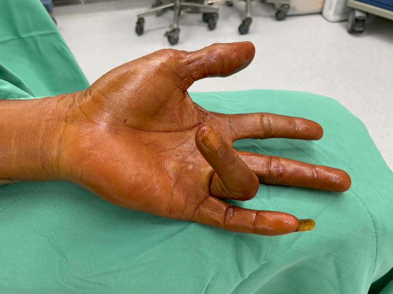 高市6旬製麵廠老闆長期肩膀疼痛合併板機指 中正脊椎骨科醫院手術加復建改善