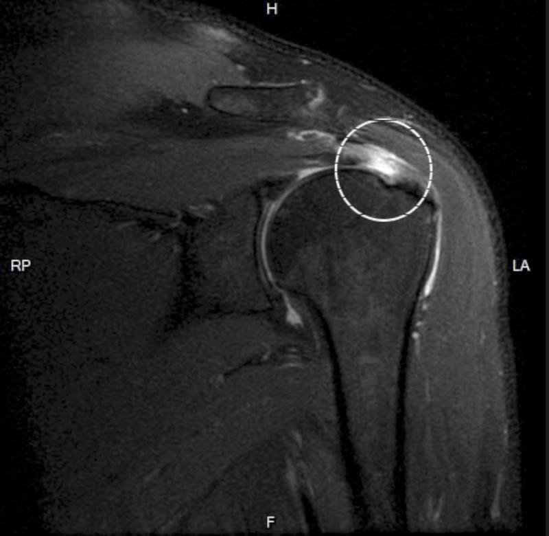 高市6旬製麵廠老闆長期肩膀疼痛合併板機指 中正脊椎骨科醫院手術加復建改善