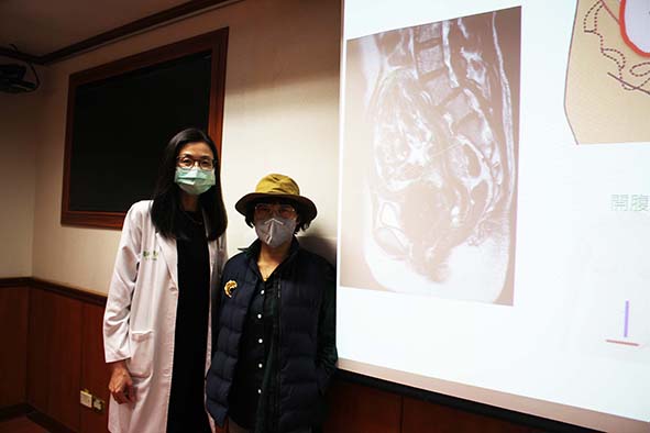高雄長庚醫院婦產部達文西經陰道自然孔術 助中年單身女切除子宮擺脫肌瘤夢魘