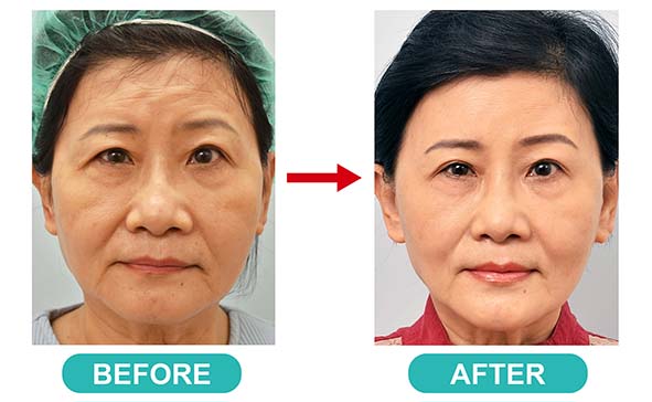 曹賜斌整形外科診所自體脂肪注射臉型改造術 助6旬諮商師撫平缺陷自然不著痕跡
