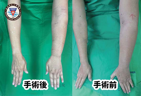 小港醫院整形外科淋巴靜脈吻合術 助乳癌病友消除肢體水腫提升生活品質