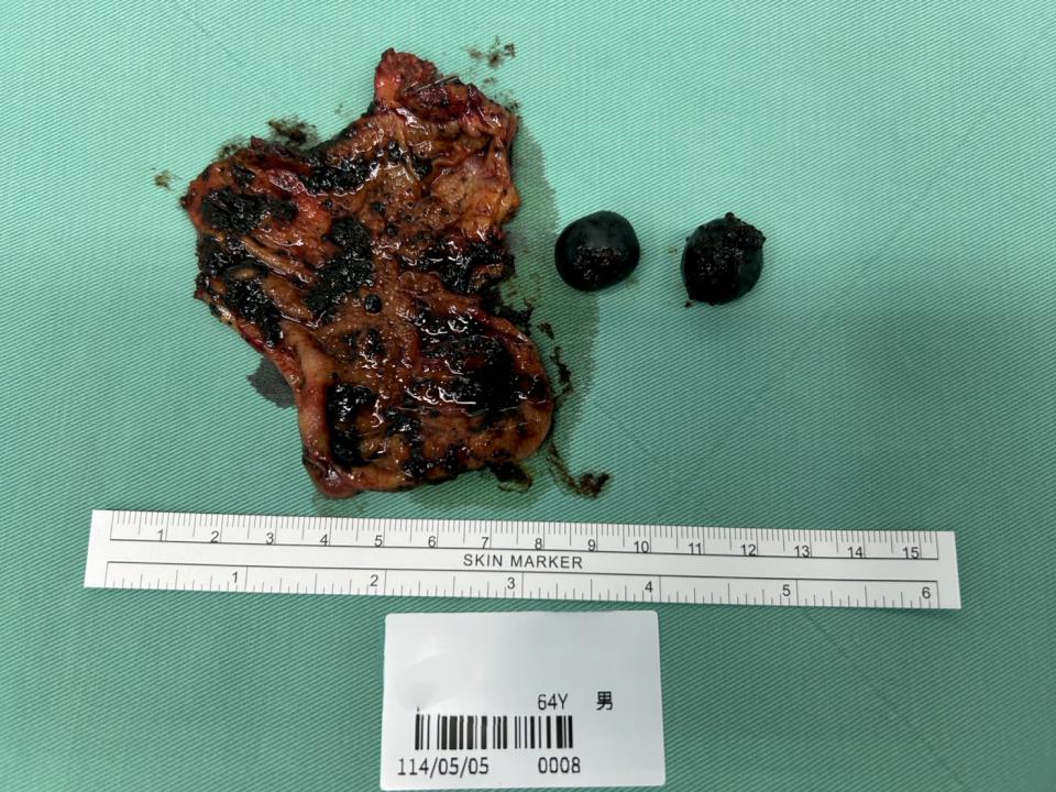 高市7旬翁罹罕見膽囊癌 博田國際醫院建議有症狀速檢查