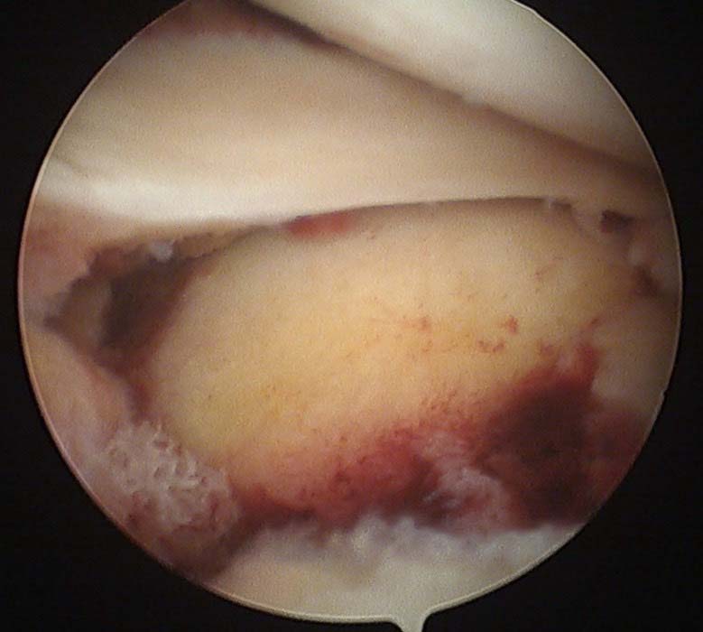 高市女照服員車禍左膝脛骨骨折 大同醫院關節鏡輔助術復健3個月正常步行