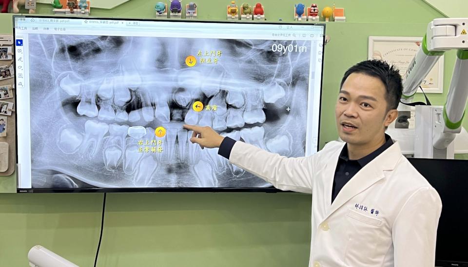 阻生齒作怪致幼童新牙難冒出頭 高市牙醫診所局部手術器械輔助矯正重建自信