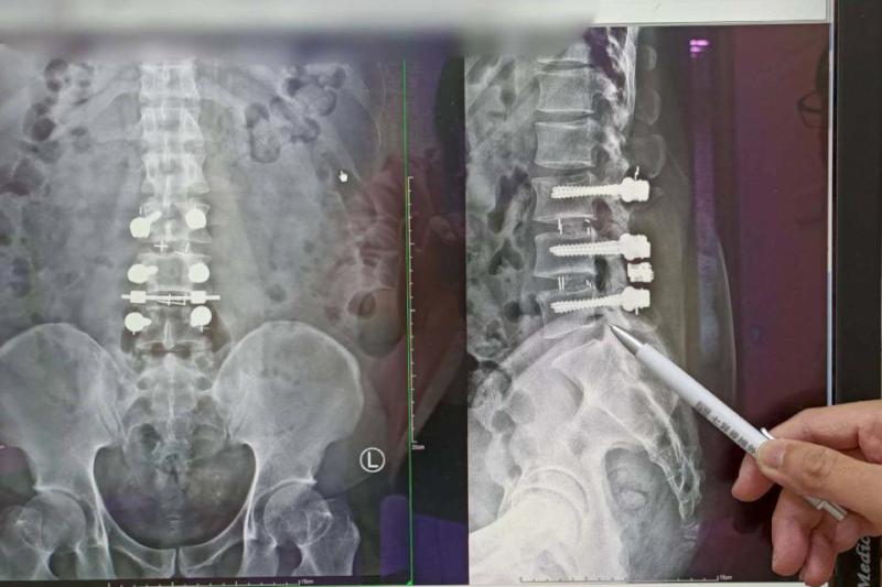 高市男工人椎間盤突出引起坐骨神經痛 七賢脊椎外科醫院高頻熱凝療法治癒