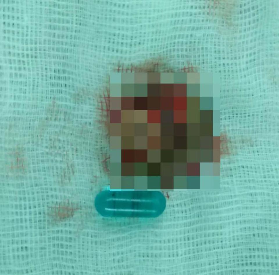 中年男陽具入珠增伴侶快感脹痛加劇 阮綜合醫院泌尿科白膜摺疊術治癒重拾雄風