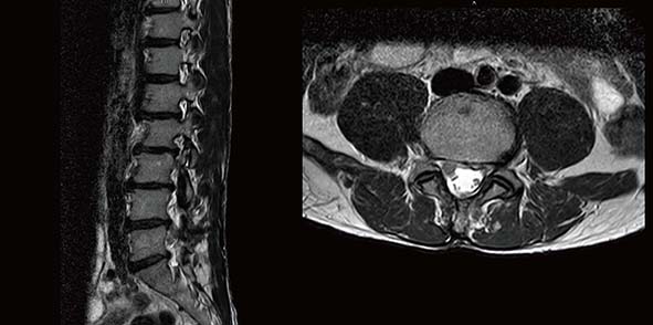 七賢脊椎外科醫院腓神經鬆解術 改善中年男小腿痛麻可正常翹起