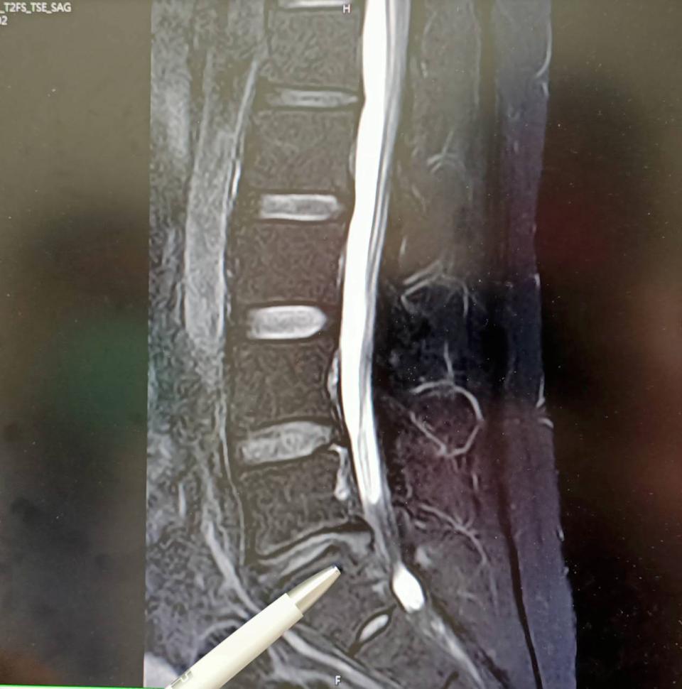 屏東青農搬重物腰痛求診七賢脊椎外科醫院 無鋼釘穩定器微創術治癒