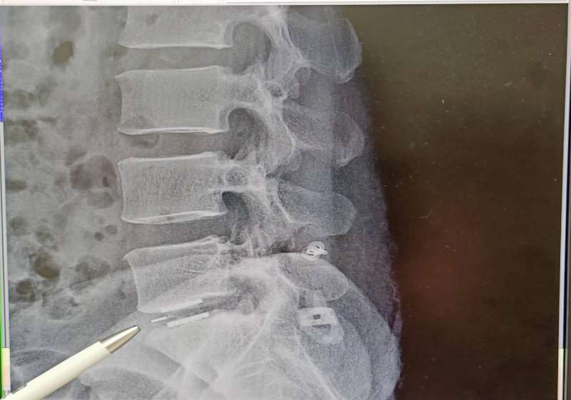 屏東青農搬重物腰痛求診七賢脊椎外科醫院 無鋼釘穩定器微創術治癒