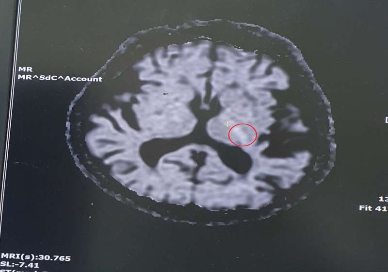 突感頭暈目眩右腳寸步難行恐罹急性缺血性梗塞 民生醫院籲節制飲食管控三高