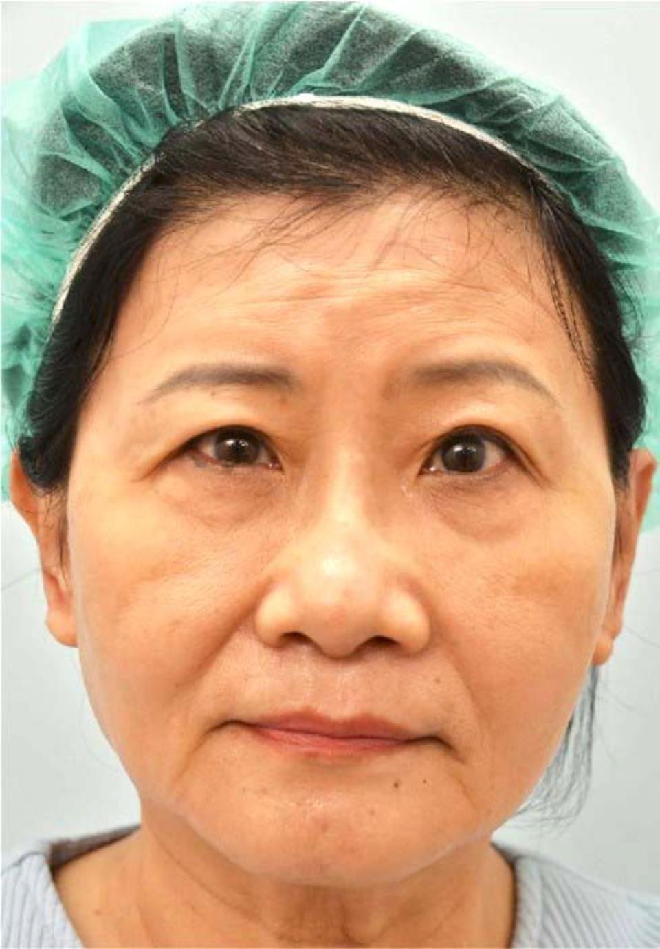 香港女打玻尿酸左臉破相 國際白疤中心創辦人曹賜斌自體脂肪注射妙手回春