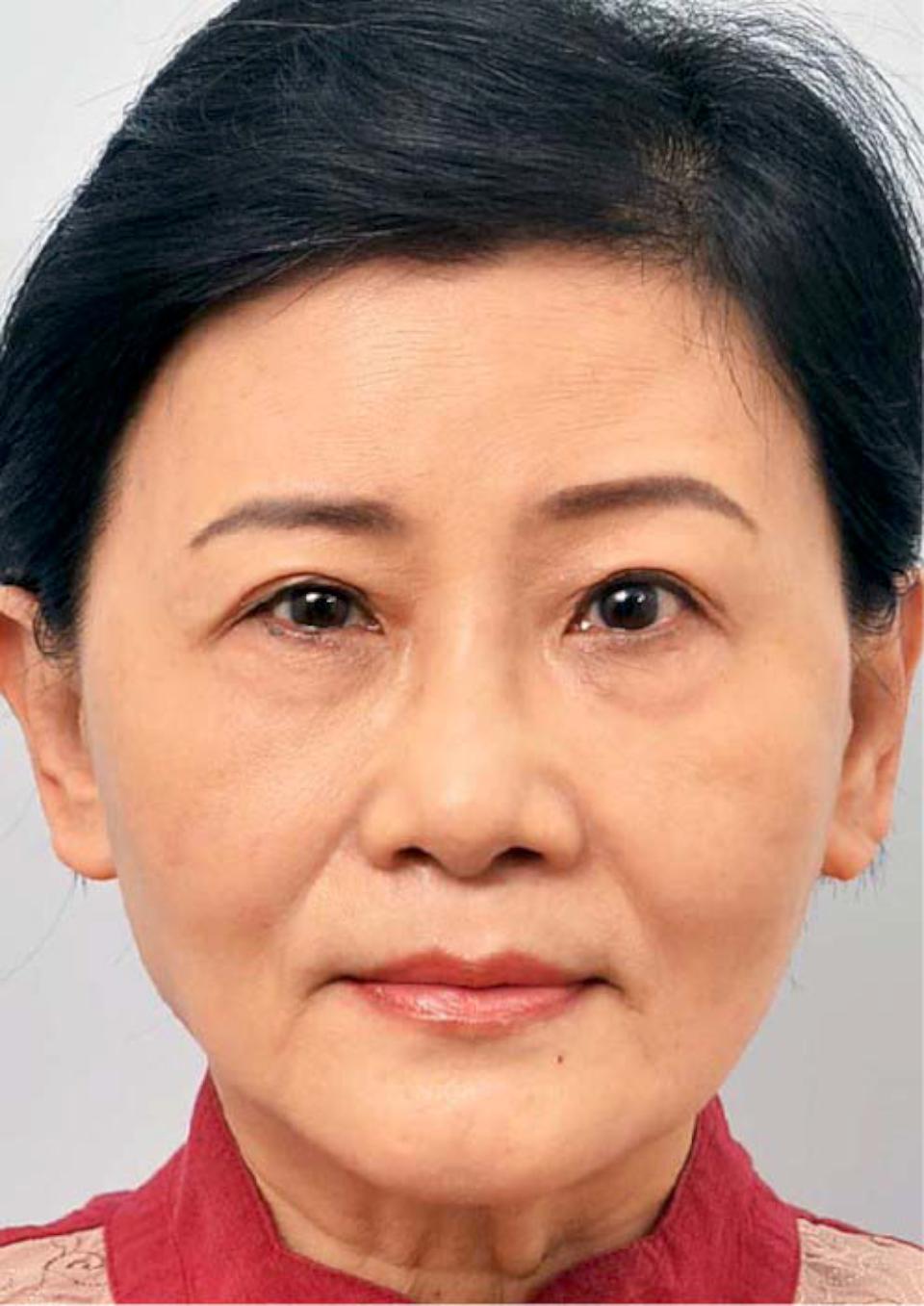 香港女打玻尿酸左臉破相 國際白疤中心創辦人曹賜斌自體脂肪注射妙手回春