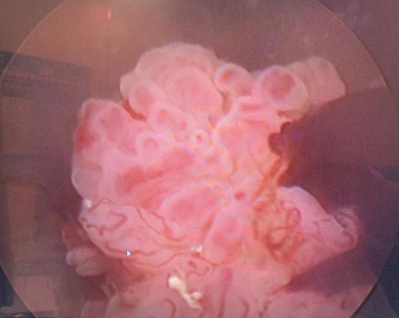 高市6旬男作業員罹兩癌致性功能障礙 阮綜合醫院泌尿科荷爾蒙配壯陽藥重振雄風