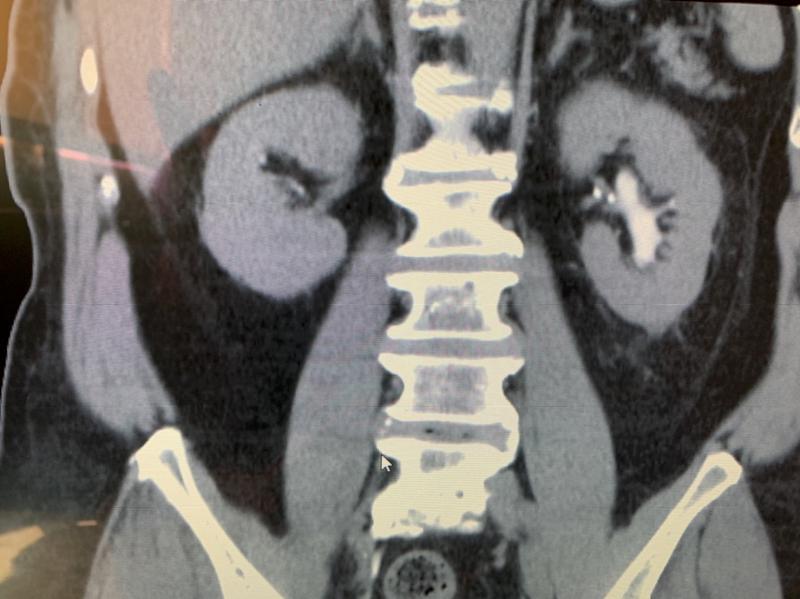 高市6旬男作業員罹兩癌致性功能障礙 阮綜合醫院泌尿科荷爾蒙配壯陽藥重振雄風